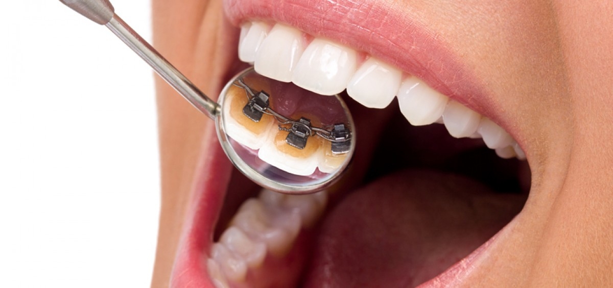 lingual_braces-1200×565 lingual_braces-1200x565